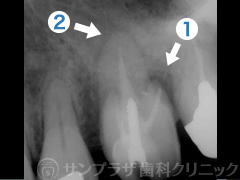 歯科用CT症例1-1