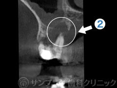 歯科用CT症例1-2