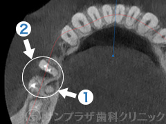 歯科用CT症例2-3