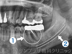 歯科用CT症例3-1