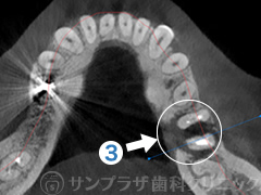 歯科用CT症例3-2