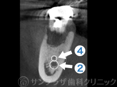 歯科用CT症例3-3