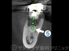 歯科用CT症例3-4